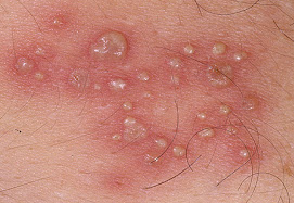 obat herpes agar tidak kambuh lagi