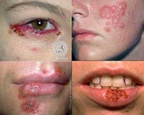 obat herpes anak2