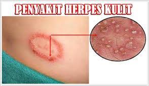 obat herpes agar cepat kering