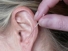 Akupunktur & Co: Nadeln fürs Lebensglück?