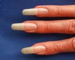 Am Fingernagel Krankheiten erkennen