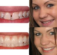 Veneers – Behandlungsmethoden und Kosten